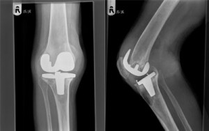 Loose Total Knee replacement